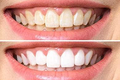 Teeth Whitening dental clinic mackay
